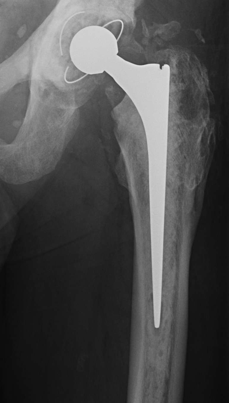 Cemented Femur Possible Loose